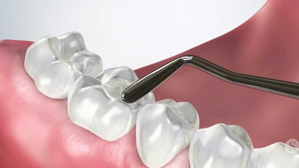 Μήπως το Χαμόγελό σου σε «Δηλητηριάζει»; Η Αλήθεια για τα Μαύρα Σφραγίσματα