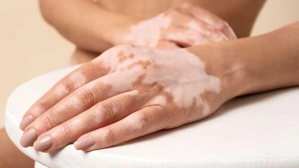 Λεύκη : Τι να προσέξετε και πως να την αντιμετωπίσετε