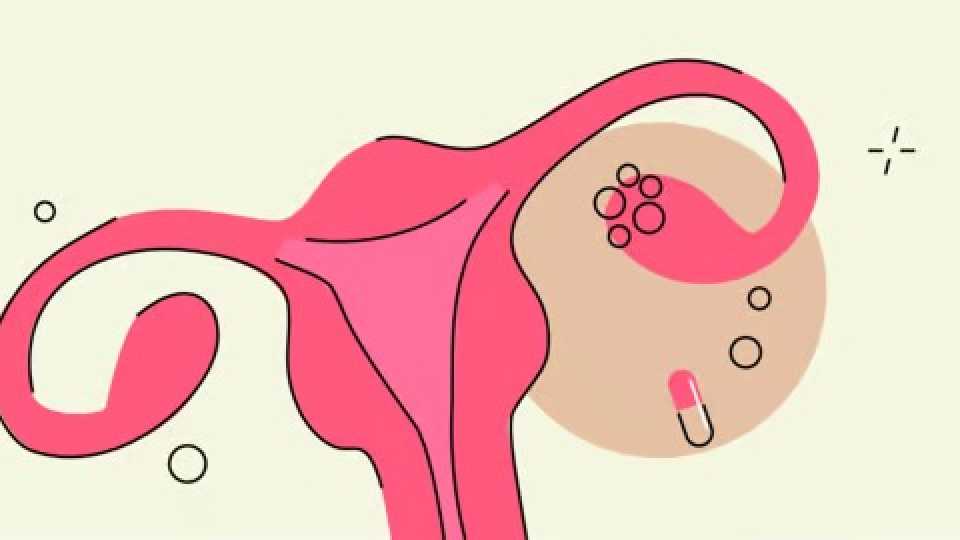 Μετφορμίνη για PCOS: Τι πρέπει να γνωρίζετε