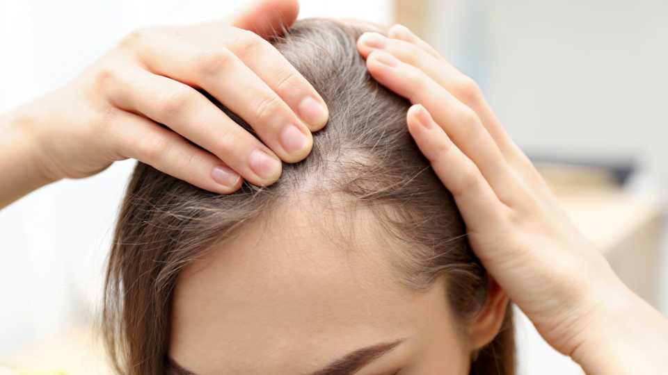 Αλωπεκία: Όλα όσα πρέπει να γνωρίζετε για την τριχόπτωση
