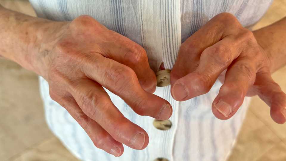 Φυσική Αντιμετώπιση της Οστεοαρθρίτιδας: Τα Βότανα κατά του Πόνου