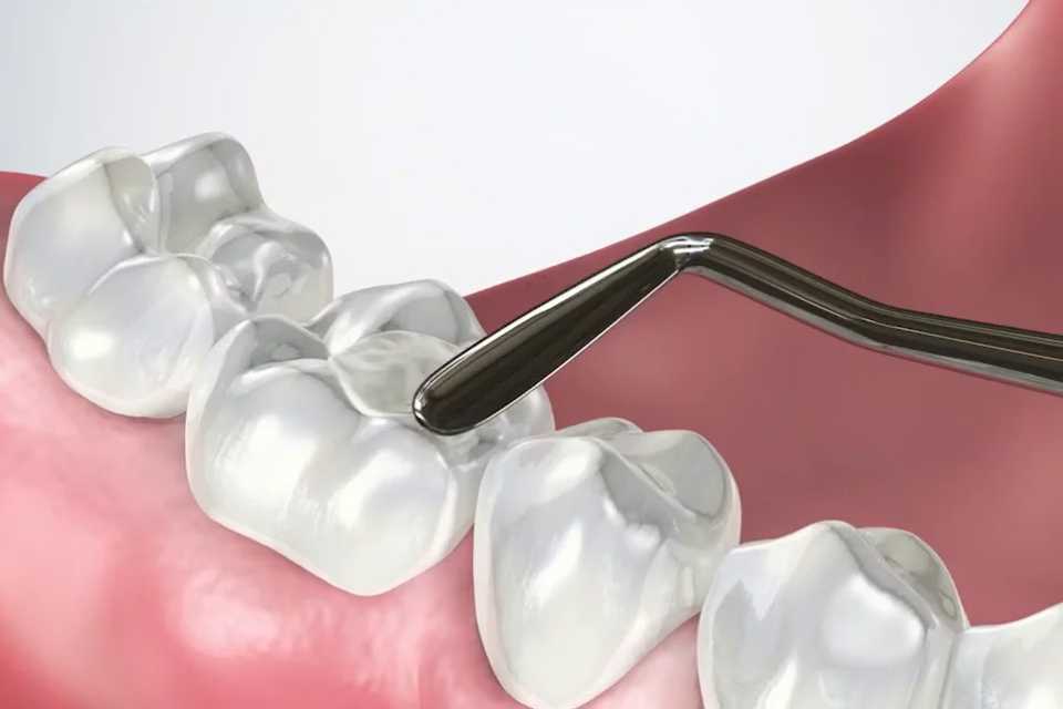 Μήπως το Χαμόγελό σου σε «Δηλητηριάζει»; Η Αλήθεια για τα Μαύρα Σφραγίσματα