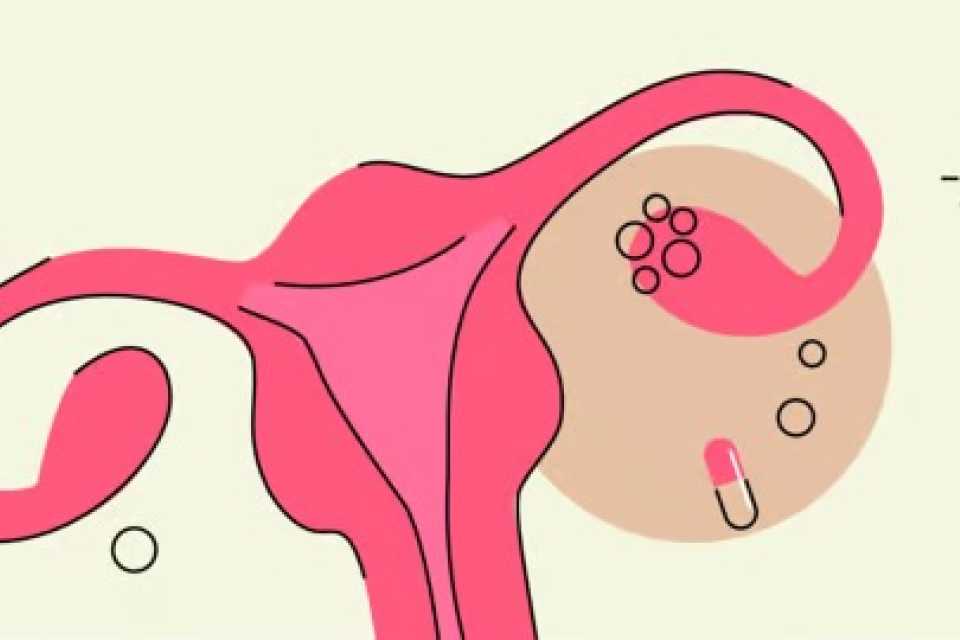 Μετφορμίνη για PCOS: Τι πρέπει να γνωρίζετε