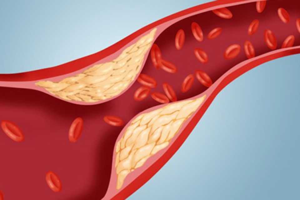 Η LDL δεν λέει όλη την αλήθεια